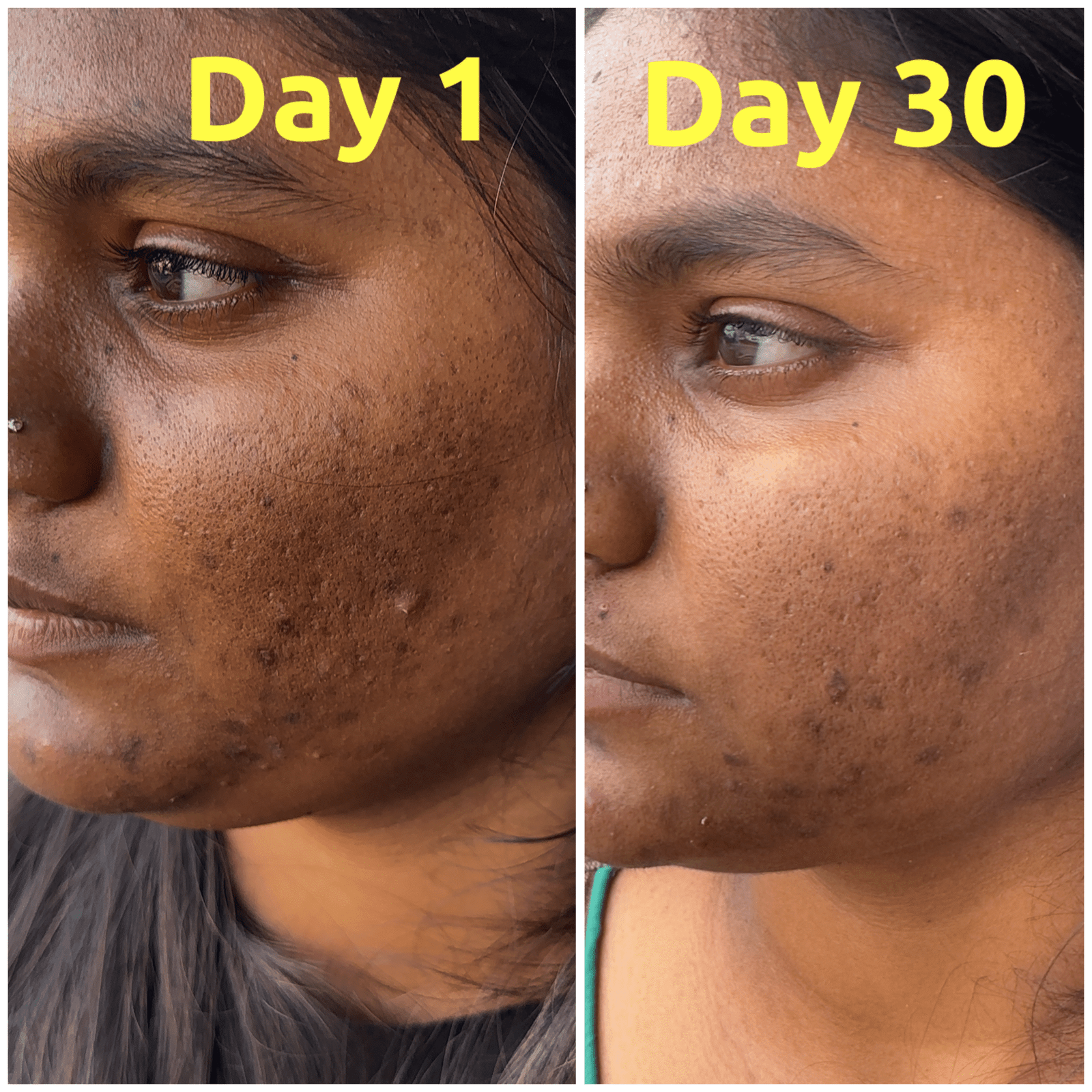 HARINI POST ACNE SCARS & DAR CICRCLESD1-D30