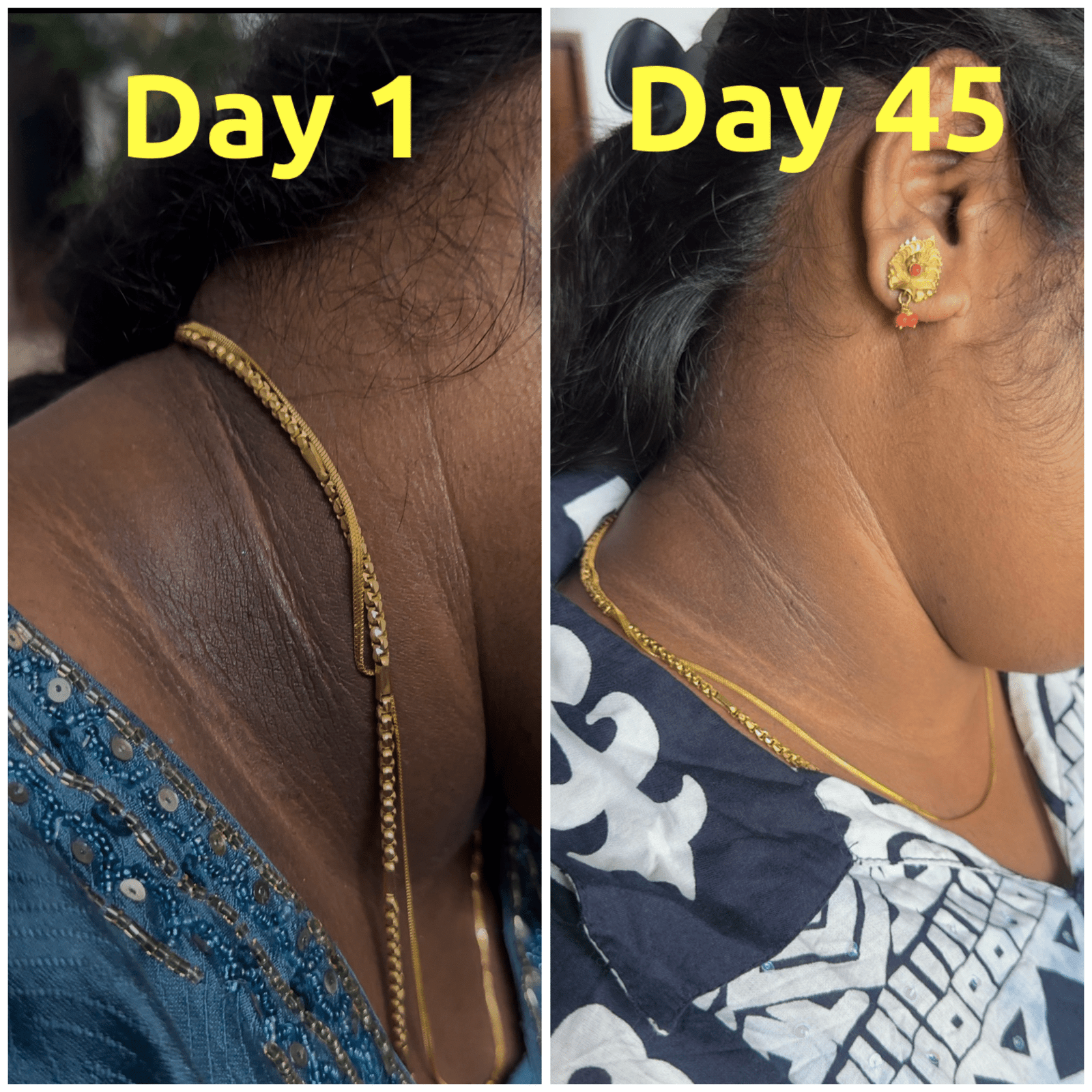 BHUVANA NECK PIGMENTATION D1-D45